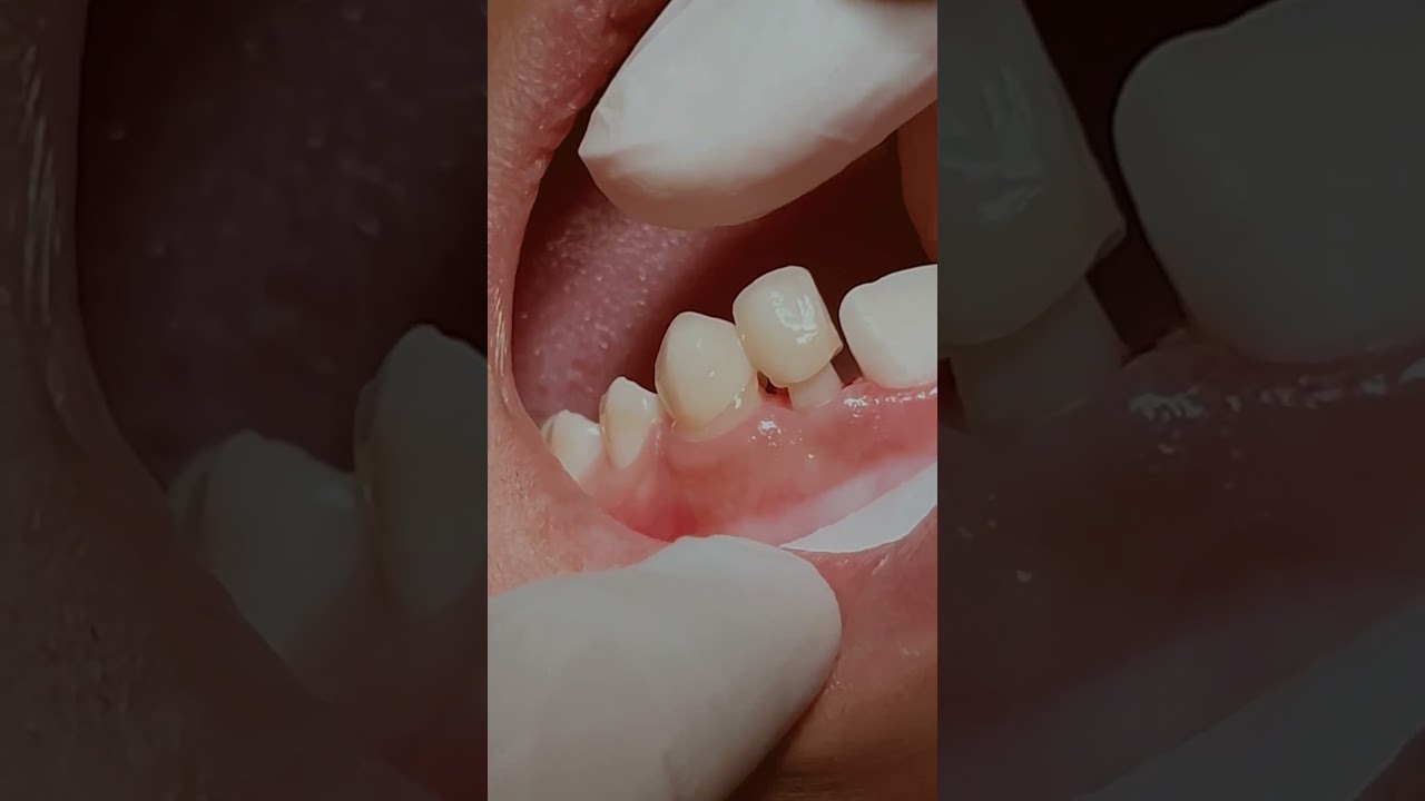 Zirconia Crowns in Dentistry 🦷