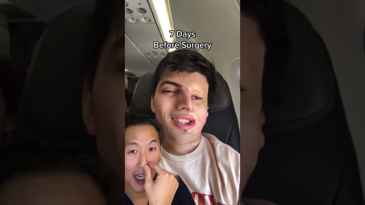 Nasal Reconstruction Surgery Countdown ⏳