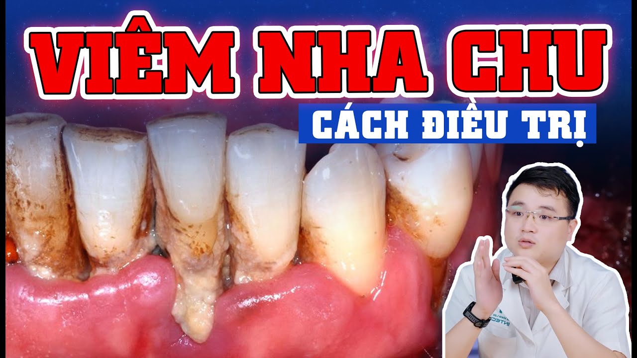 Viêm Nha Chu - Dấu Hiệu Cảnh Báo Sớm Và Cách Điều Trị Để Ngăn Ngừa Hệ Luỵ Mất Răng