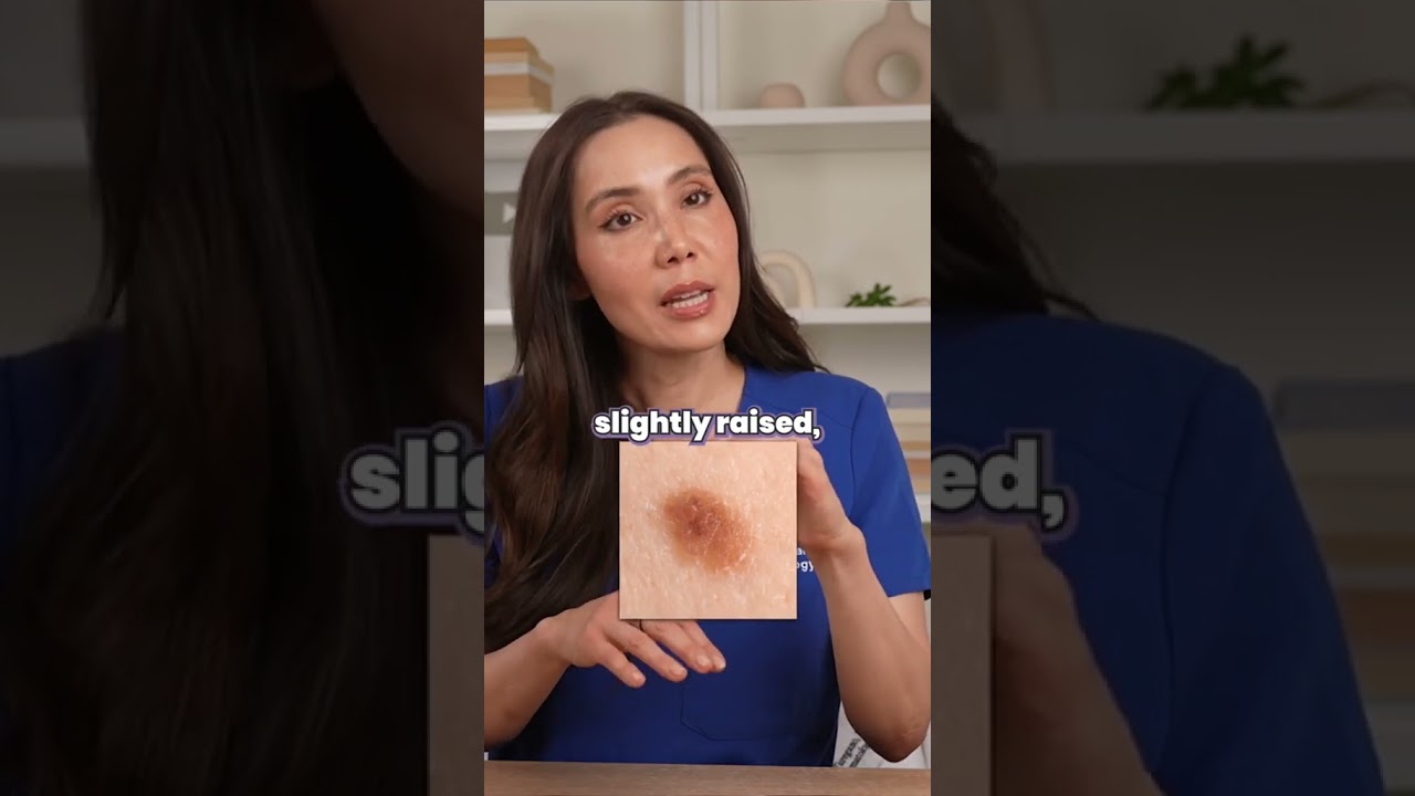 Understanding Moles: Types and Risks 🧐