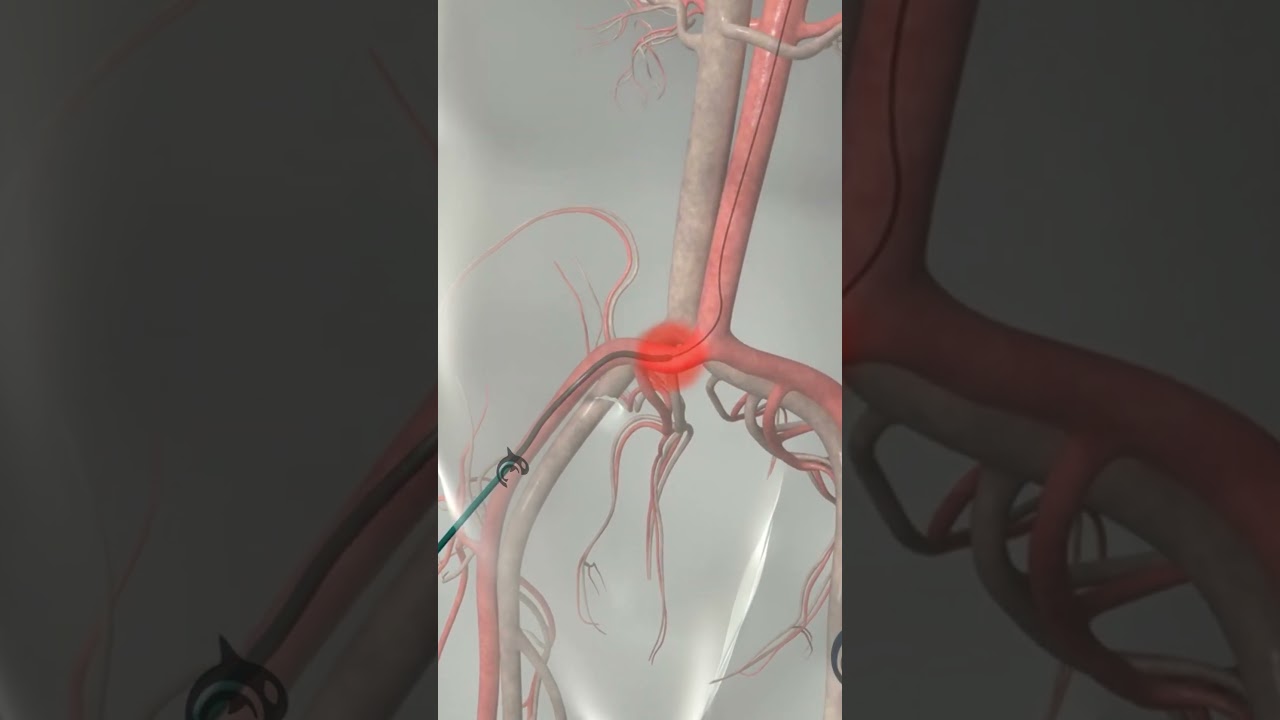 Discover How Cardiac Catheterization Works 🫀