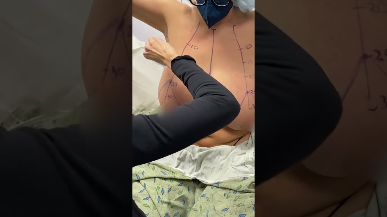 Is Breast Reduction Surgery Worth It? Discover the Benefits! β¨