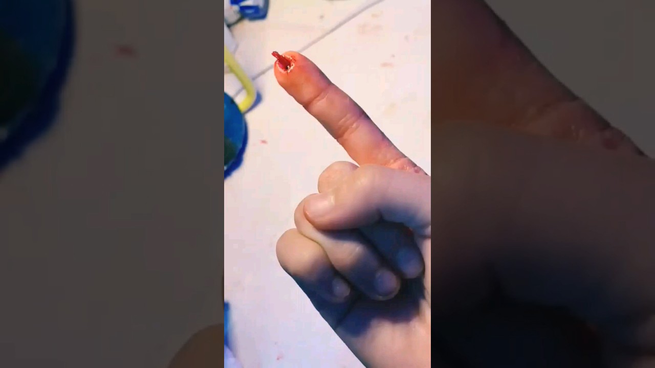 Ouch! My Finger Is Killing Me 😱 | Quick Fix & Tips