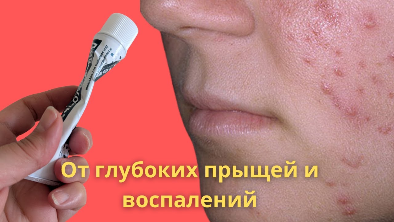 Лечение глубоких прыщей и воспалений в домашних условиях 🧴