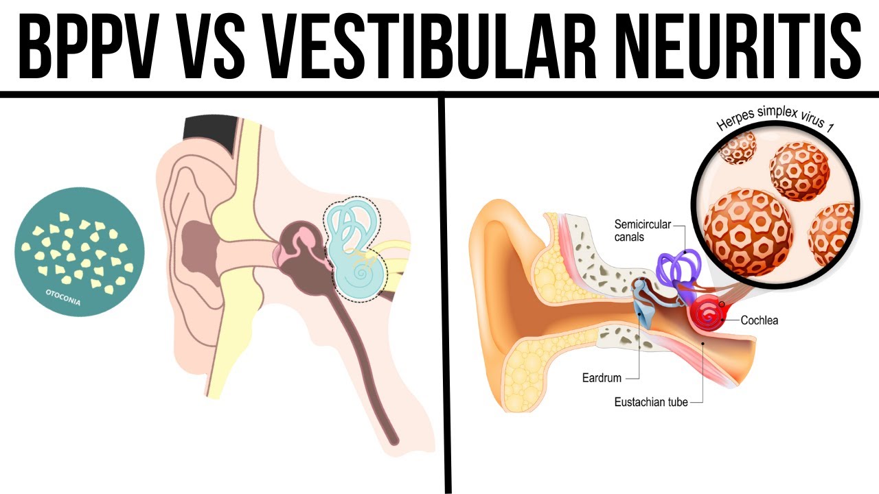 BPPV vs Vestibular Neuritis: Key Differences 🌀