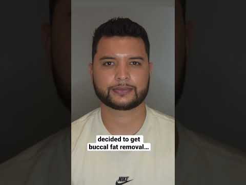 How to slim your face #beforeandafter