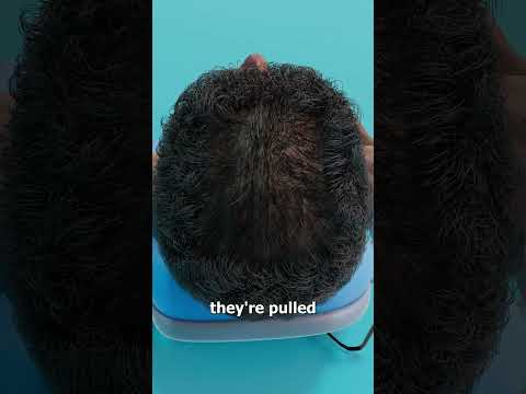 How Scalp Reduction Surgery Works 🤔