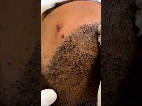 🚀43M+ Views | It’s not just a regular head wash 🚿| Hair Transplant Clinic in Delhi