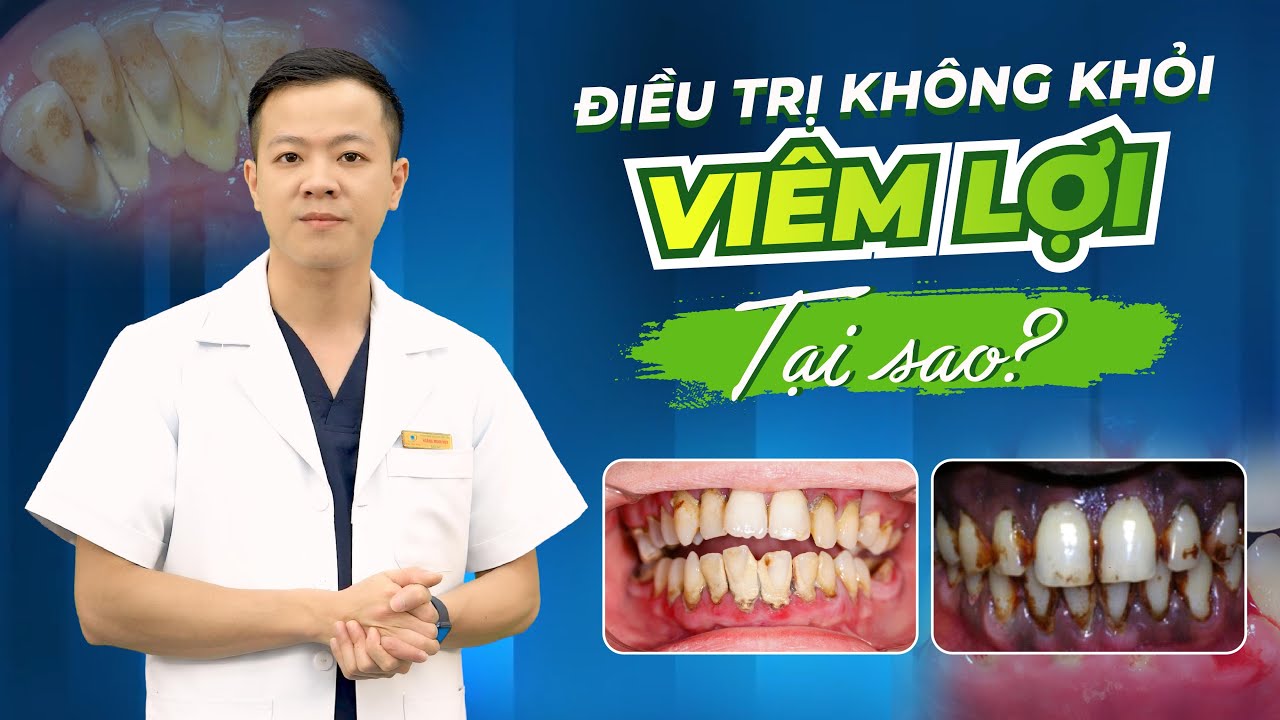Tại sao viêm lợi không khỏi? Nguyên nhân & cách điều trị