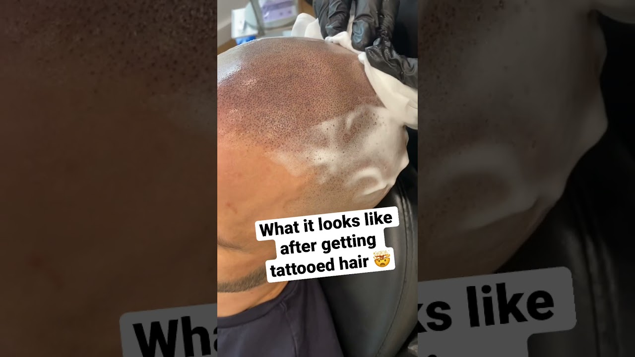 Scalp MicroPigmentation: Top Hair Loss Solution 💇‍♂️