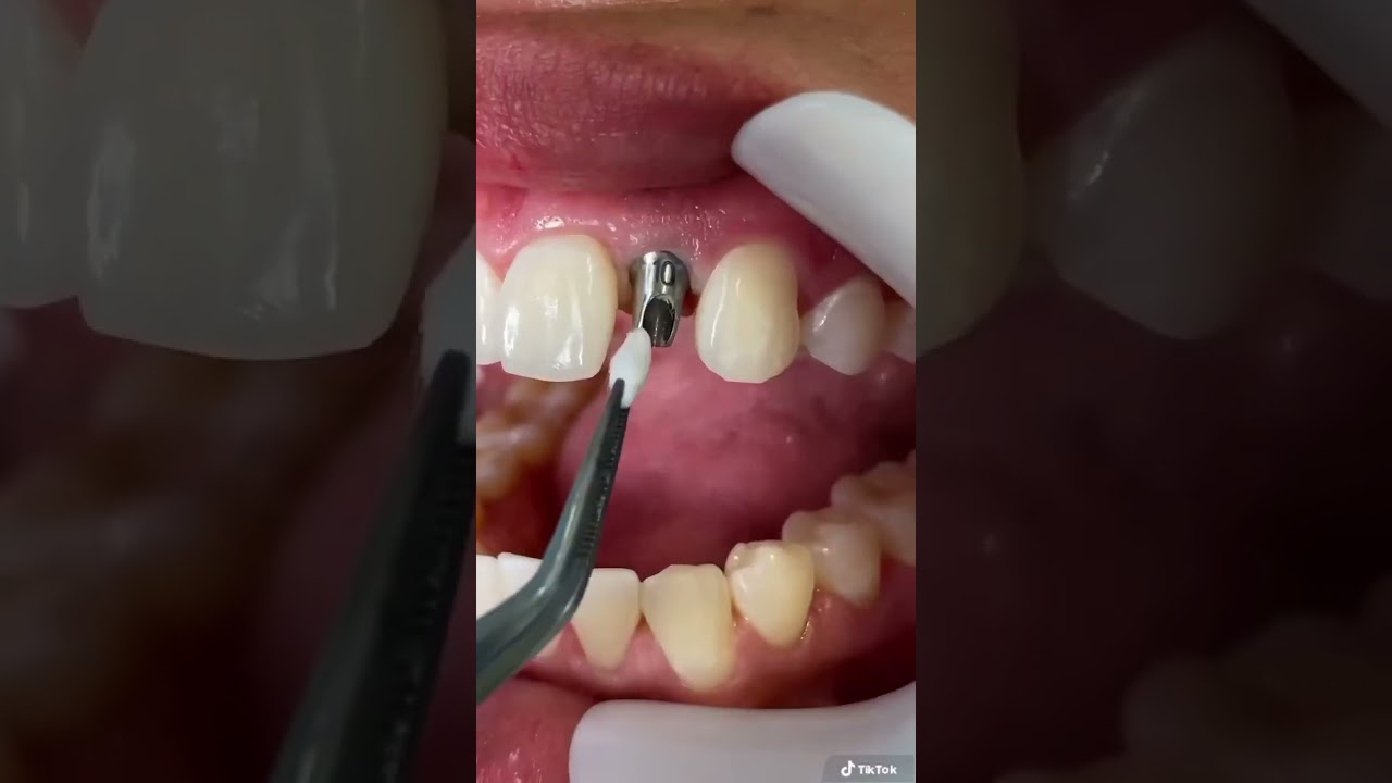 Trồng Răng Đơn Giản Dễ Dàng 🤪