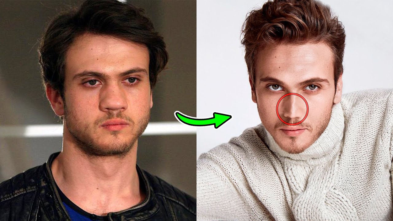 Турецкие актёры, которые сделали пластическую операцию: до и после 2022 📸