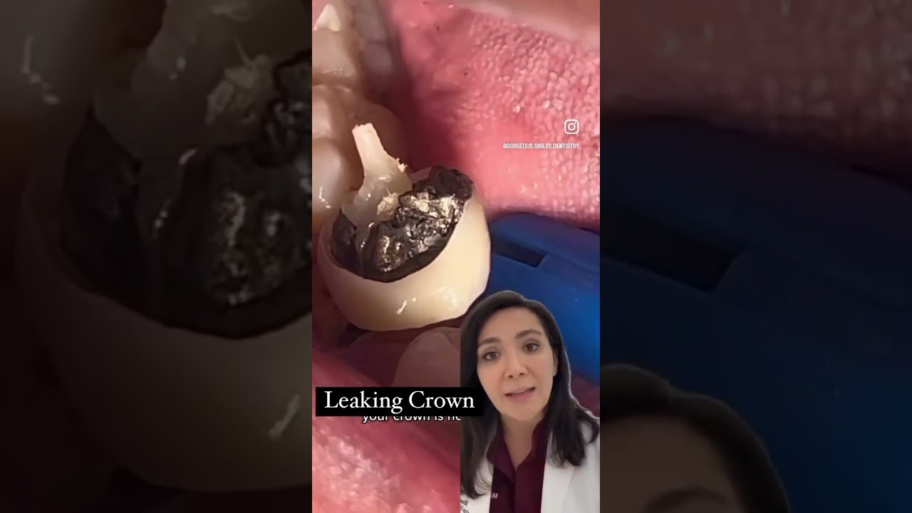 How Do Dental Crowns Leak? 🦷