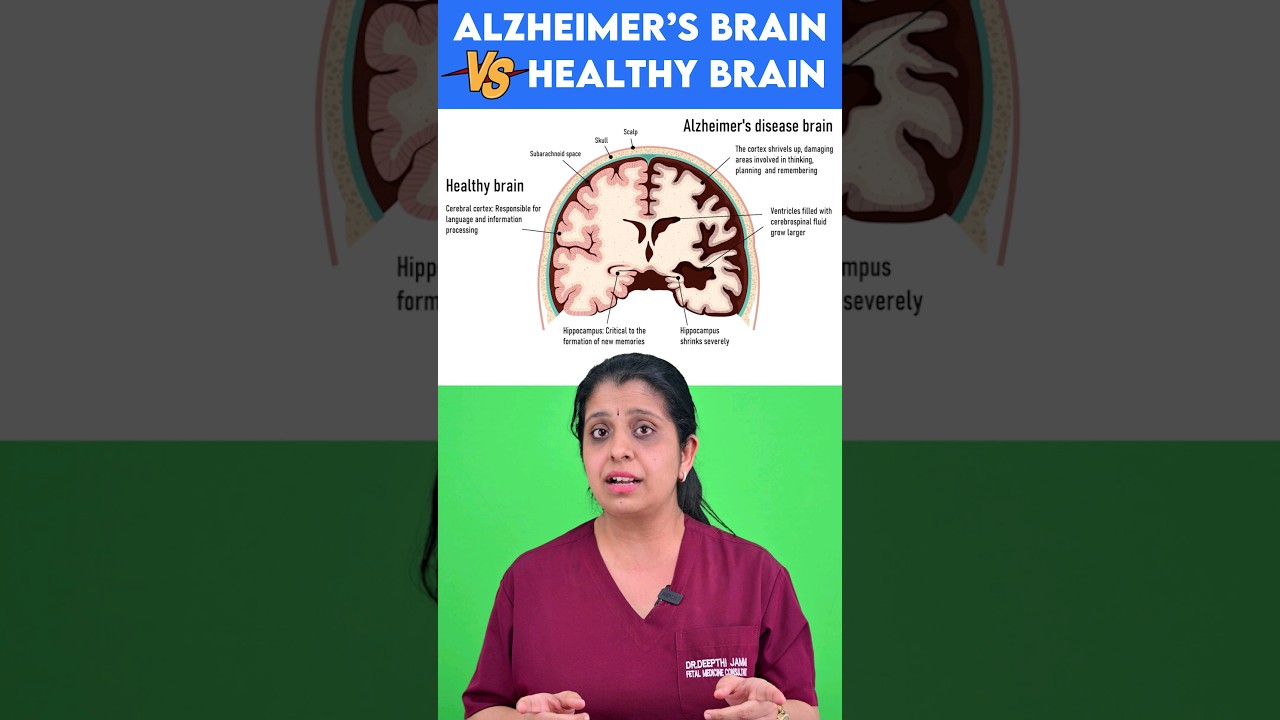 Alzheimer's vs Healthy Brain 🧠