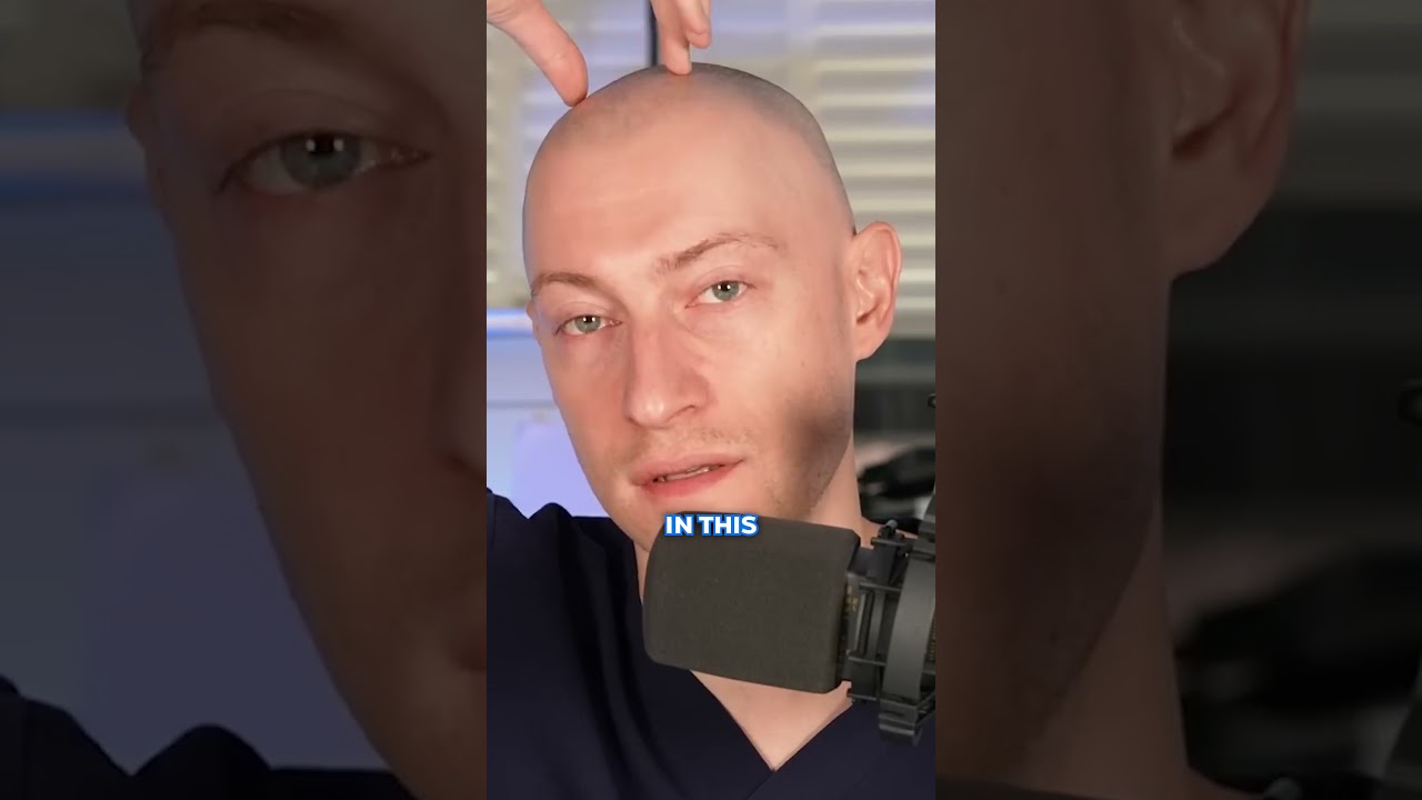 How Does A Hairline Impact A Hair Transplant?