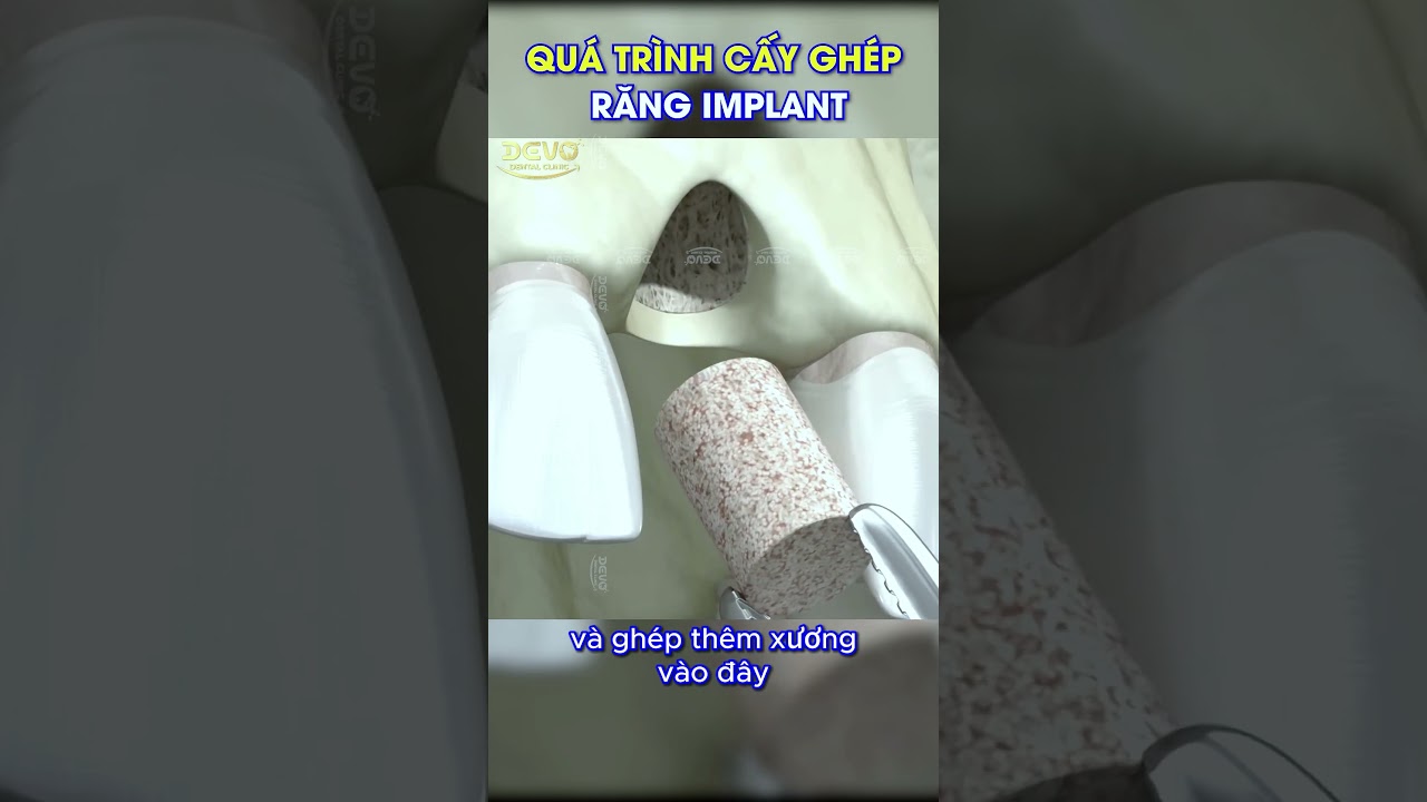 Quy trình cấy ghép răng implant & nâng xương 🦷