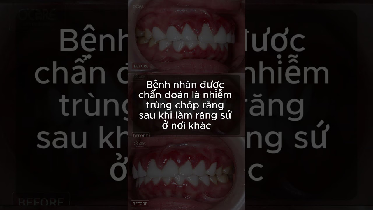 Chăm sóc viêm nướu sau bọc răng sứ 🦷