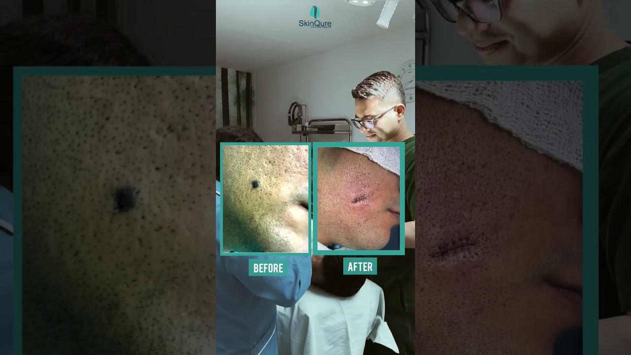 Mole Removal with Surgery & Laser ✨