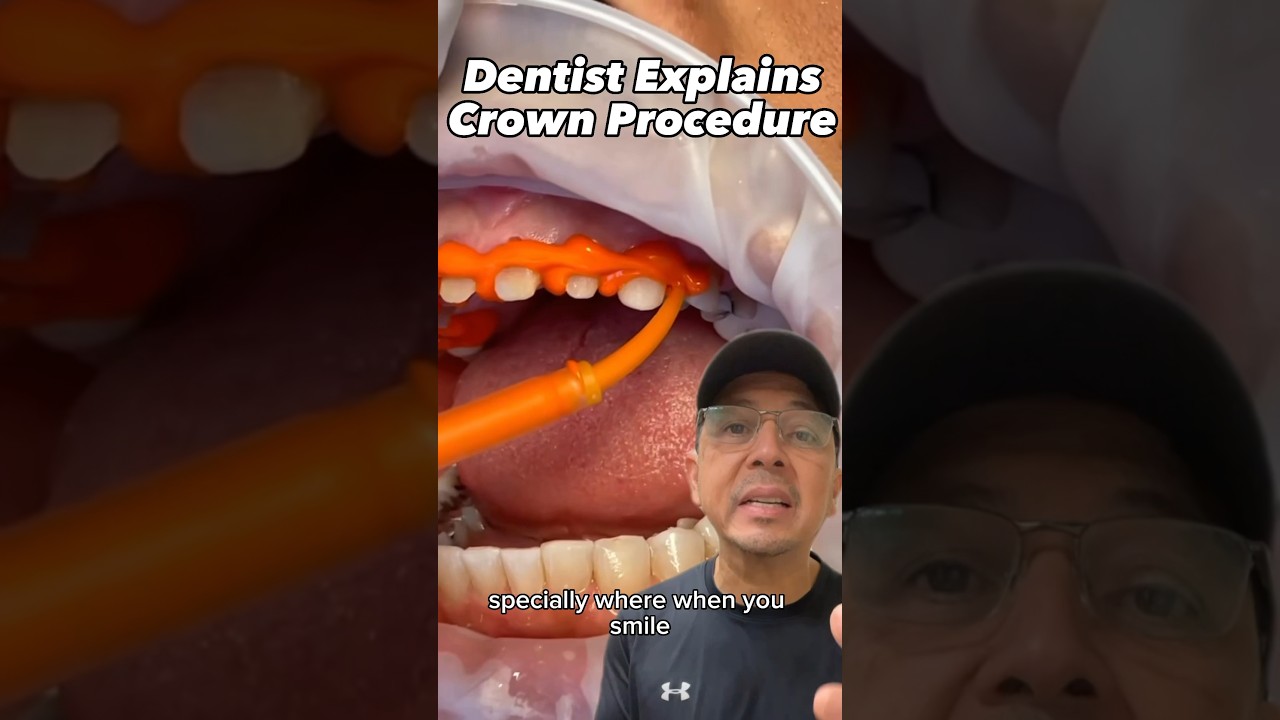 Dental Crown Procedure (How Long Does It Take to Get a Crown?) | View Mobile Dental #shorts