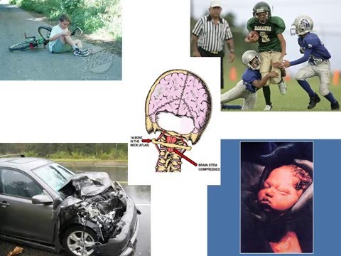 How Common Is An Upper Cervical Misalignment?