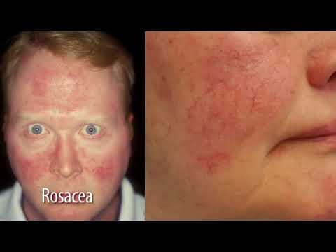 Rosacea iS Clinical Skincare South Africa