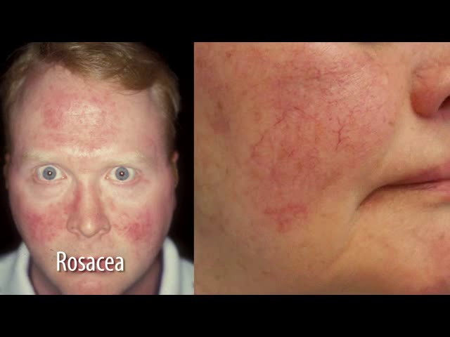 iS Clinical Skincare for Rosacea in South Africa