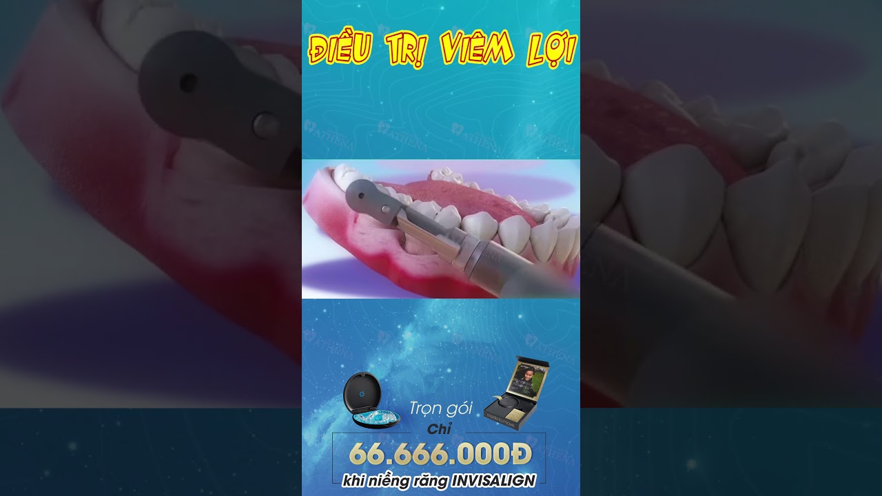 [3D] Điều Trị Viêm Lợi tại Nha Khoa Athena