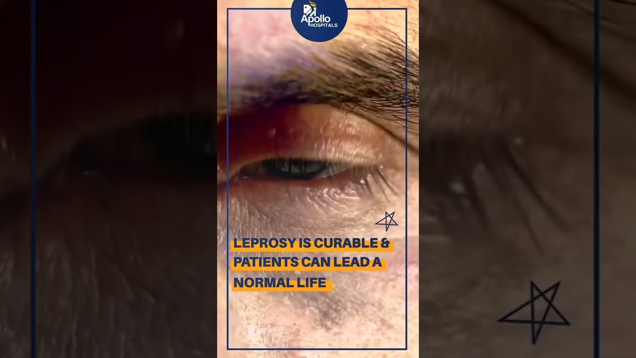 Myth Busting: Leprosy Facts & Misconceptions 🩺