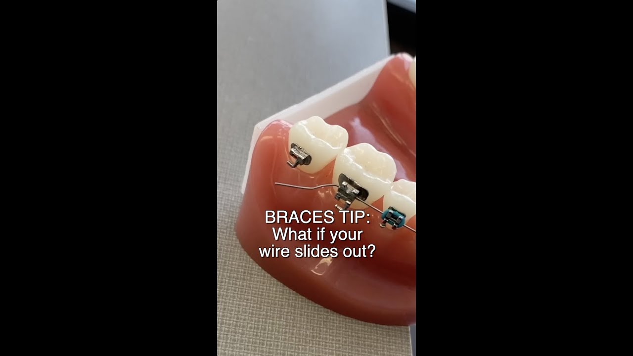 Braces Wire Poking Cheeks? Quick Fix Guide π¦·