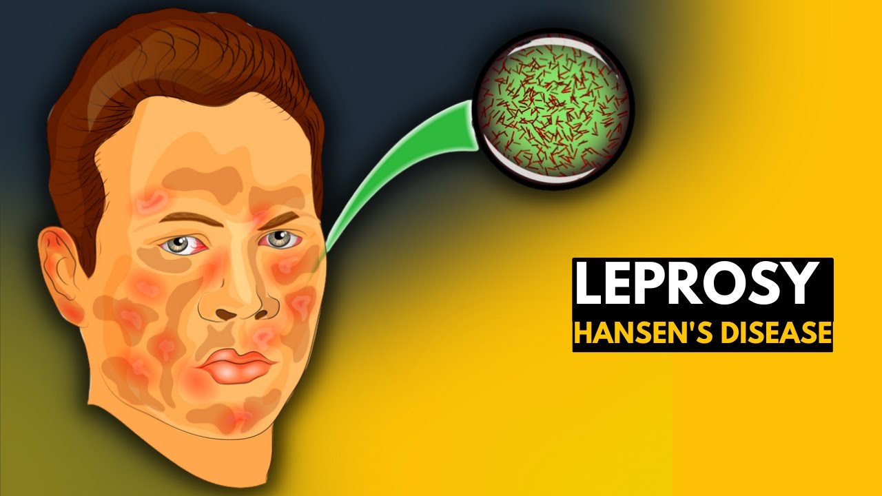 Leprosy (Hansen's Disease): Causes, Symptoms & Treatment 🩺