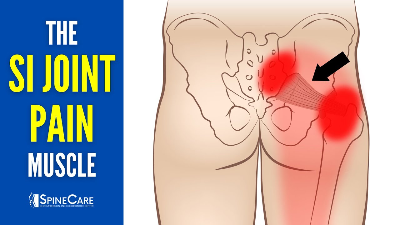 The Sacroiliac Joint Pain Muscle (How to Release It for INSTANT RELIEF)