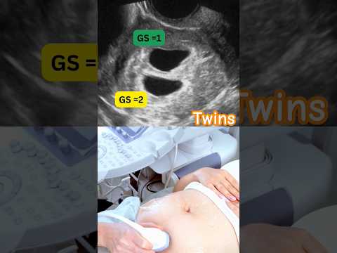 Early Ultrasound Shows Twins #twins #pregnancy #ultrasound