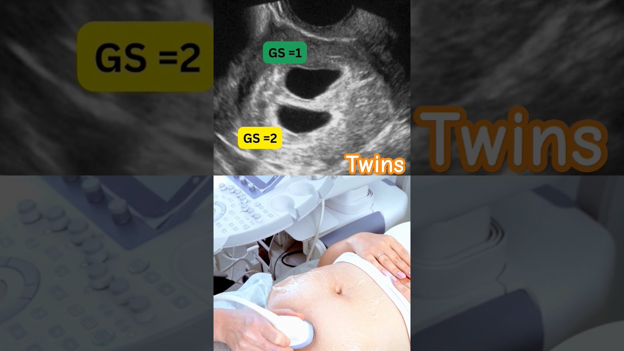 Exciting News! Early Ultrasound Reveals Twins πΆπΆ