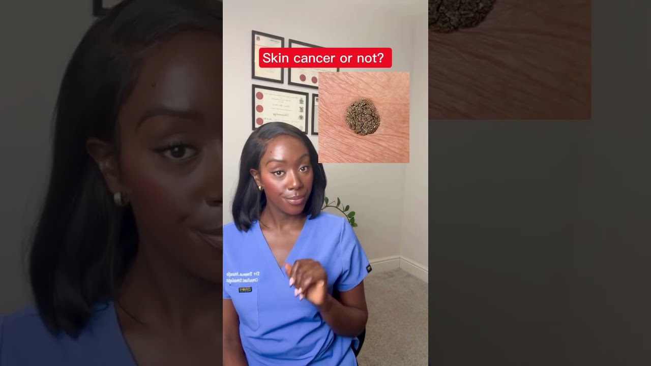 Could Your Mole Be Skin Cancer? 🩺