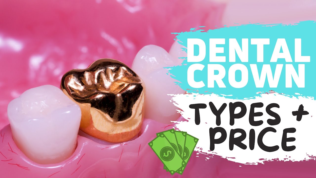 Dental Crowns Guide: Types, Costs & Tips 🦷