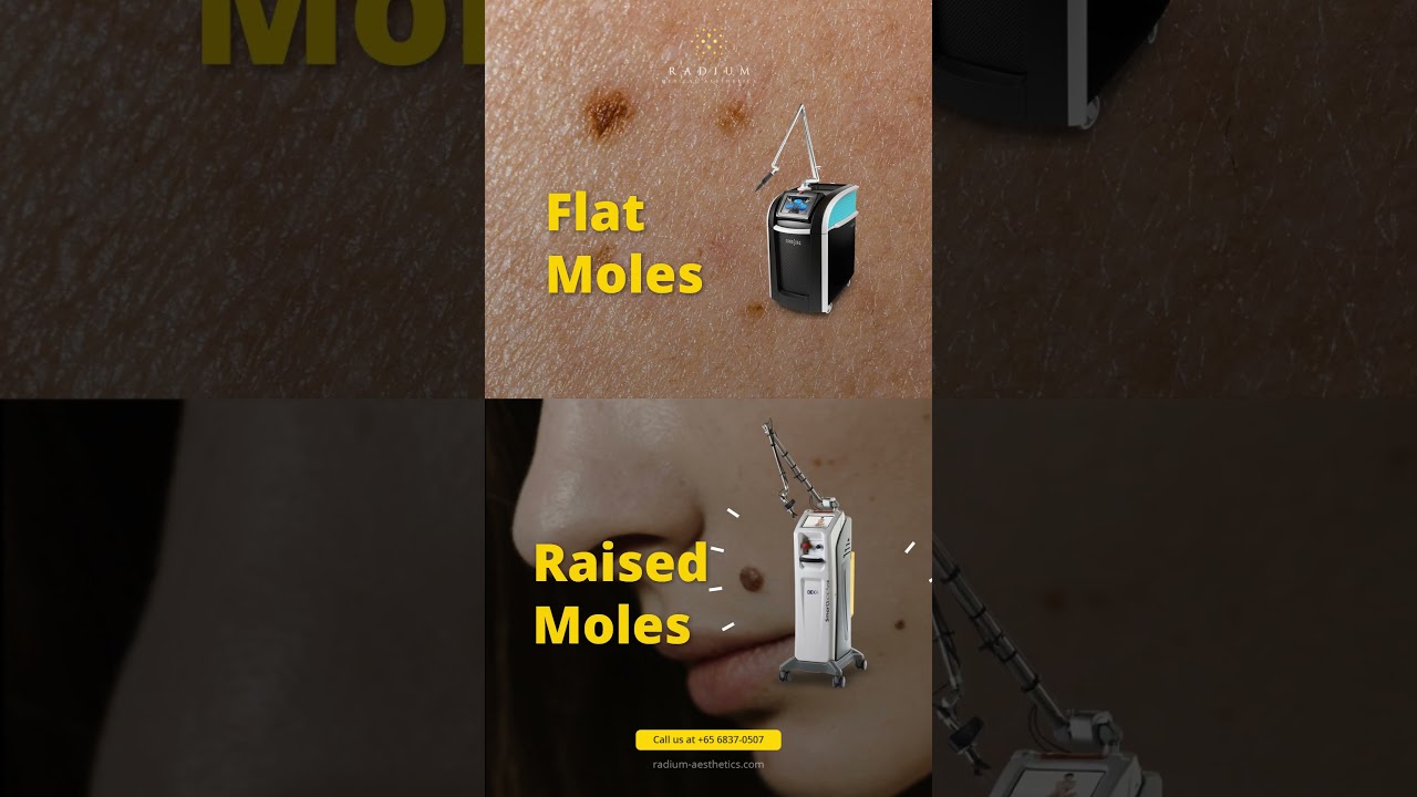 Laser Removal of Moles & Pigmentation ✨