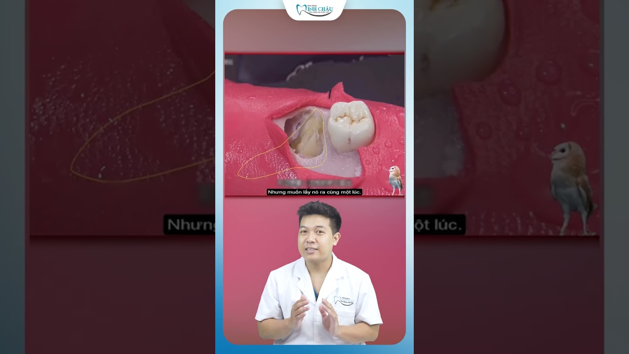 Nhổ Răng Khôn Có Đau Không? | Nha Khoa Minh Châu