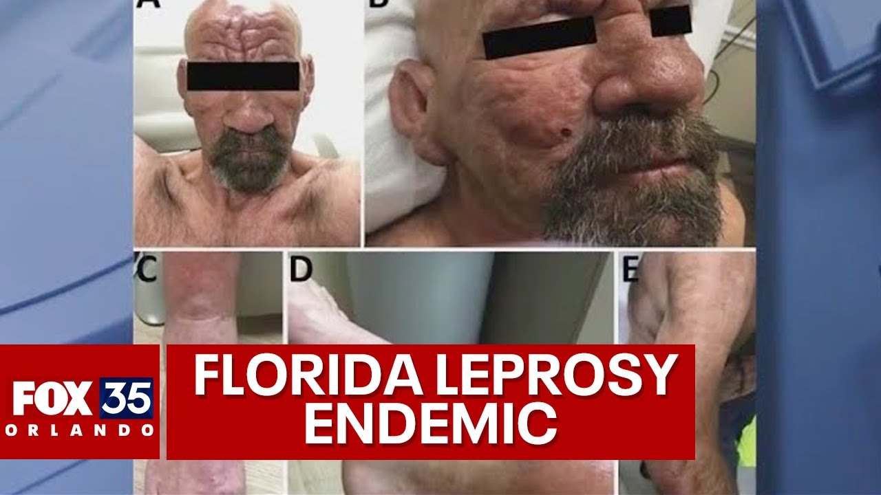 Leprosy Endemic in Central Florida, CDC Warns 🦠