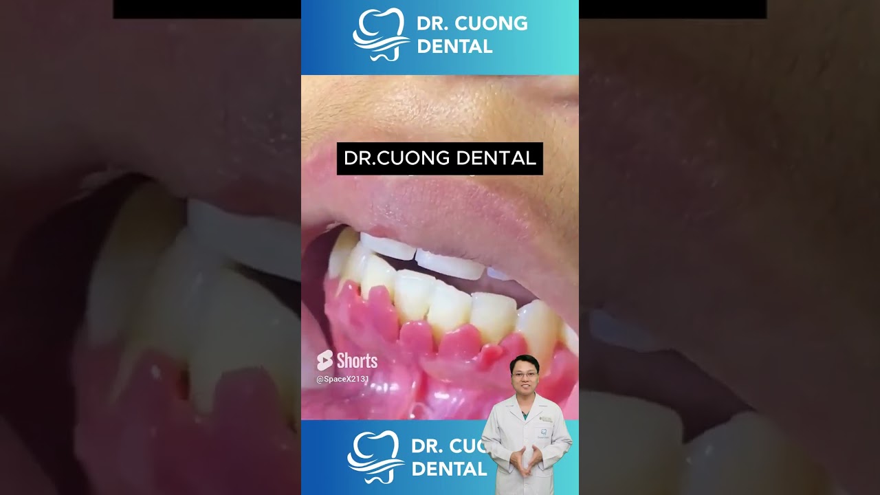 OMG! Viêm Lợi Sẽ Như Thế Nào |Dr Cường Official