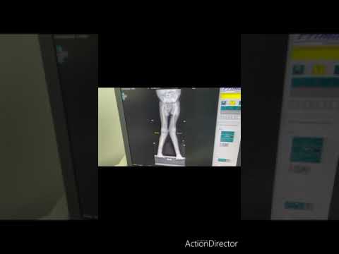 La télémétrie des membres inférieurs/Genu valgus