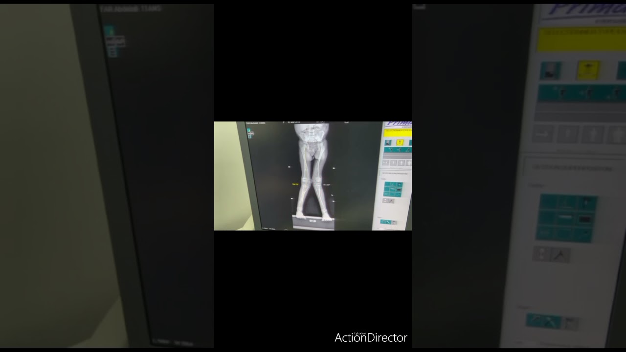 Télémétrie des Membres Inférieurs : Analyse du Genu Valgum et des Asymétries 🎯