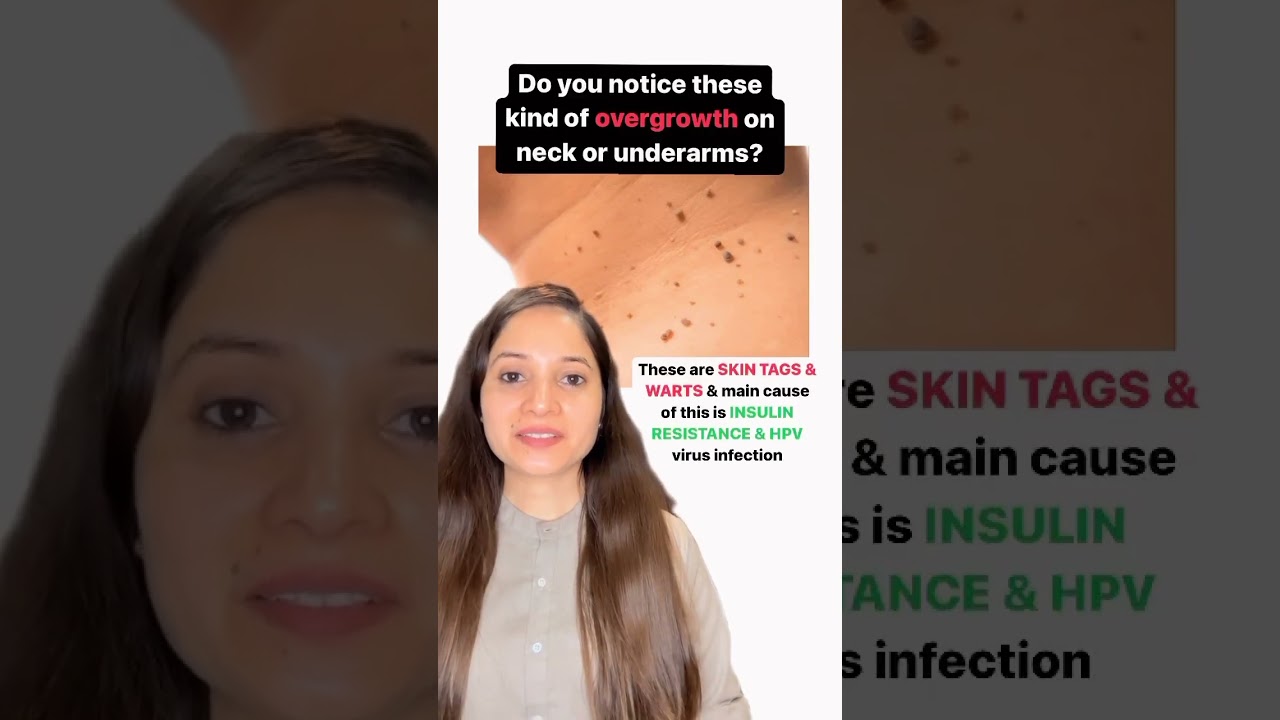 Natural Ways to Remove Skin Tags & Warts ✨
