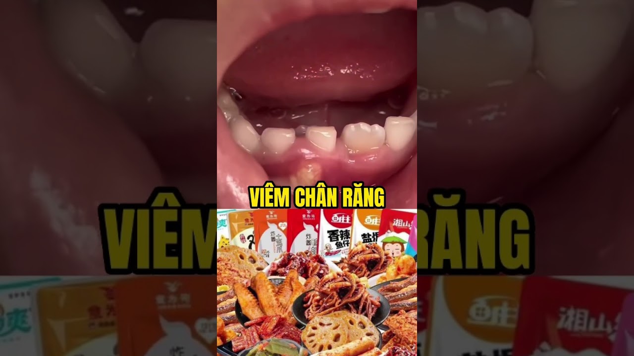 Viêm Chân Răng Có Mủ: Triệu Chứng & Cách Điều Trị