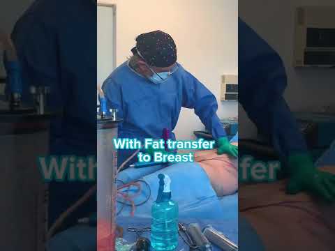 Lipo 360º + Fat transfer to breast by Dr.Bucio #plasticsurgery #lipo360 #tijuana #sandiego #lipo