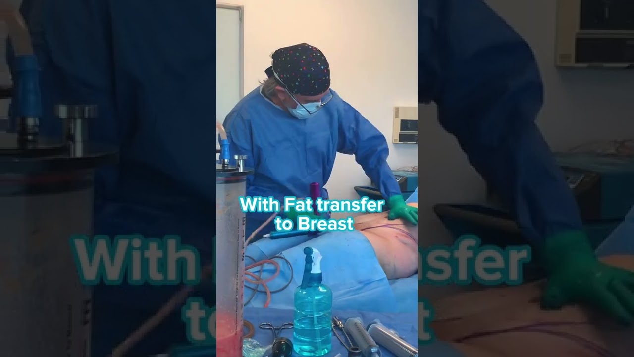 Transform Your Look with Lipo 360º & Breast Fat Transfer by Dr. Bucio ✨