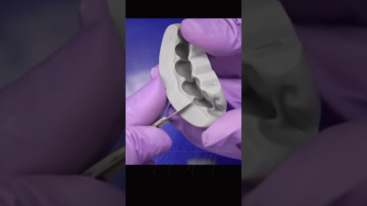 Immediate Temporary Dental Crown 🦷