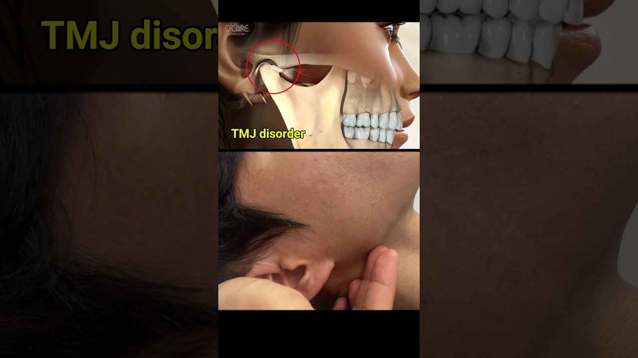 Effective Treatments for TMJ Disorder: Relief & Solutions 🦷