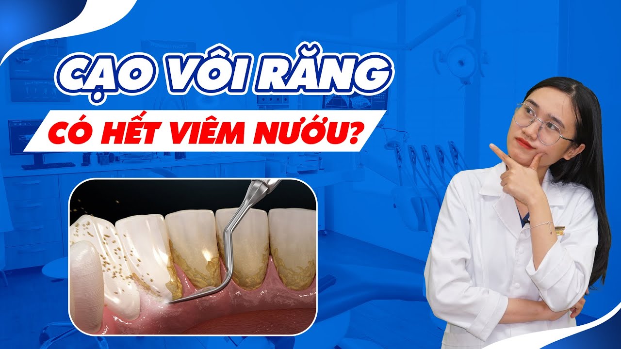 Cạo Vôi Răng Có Giúp Hết Viêm Nướu? | Nam Bùi Vinalign