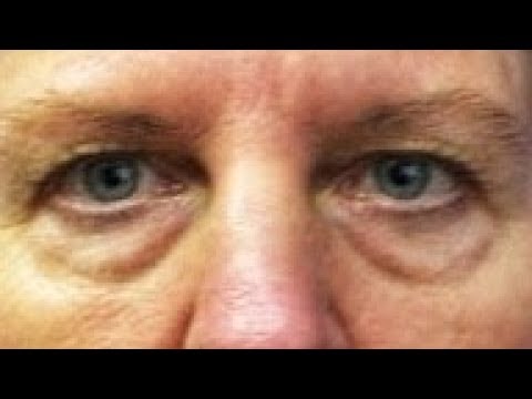 Быстрое избавление от мешков и кругов под глазами 💧