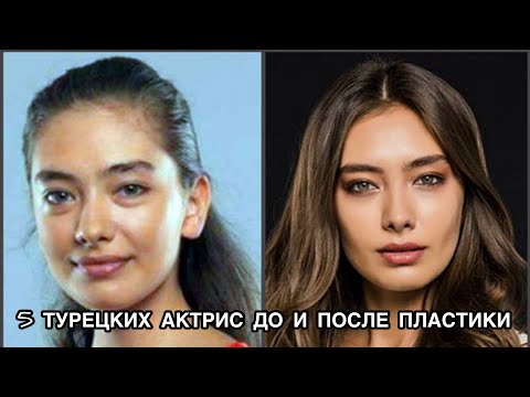 5 ТУРЕЦКИХ АКТРИС ДО И ПОСЛЕ ПЛАСТИКИ. Турецкие актрисы. Турецкие актёры. Турецкие сериалы.